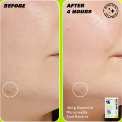 Revolution Skin Super Dart Microneedle Salicylic Acid Hydrocolloid Spot Patches 9 Patches